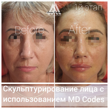 Контурная пластика скул
                    Косметолог Алена Харьков