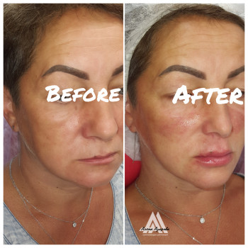 Контурная пластика скул
                    Косметолог Алена Харьков