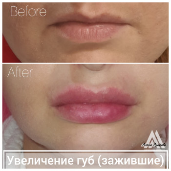 Увеличение губ
                    Косметолог Алена Харків