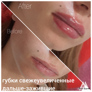 Увеличение губ
                    Косметолог Алена Харків