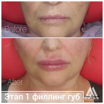 Увеличение губ
                    Косметолог Алена Харків