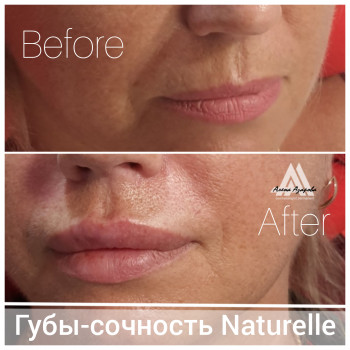 Увеличение губ
                    Косметолог Алена Харків