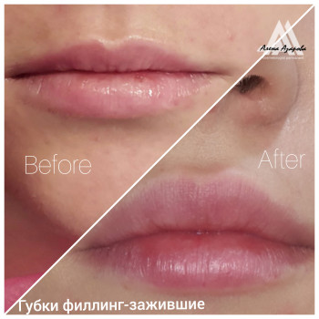 Увеличение губ
                    Косметолог Алена Харків