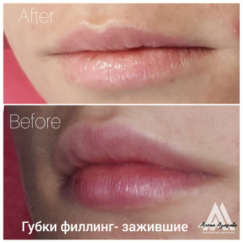Увеличение губ
                    Косметолог Алена Харків