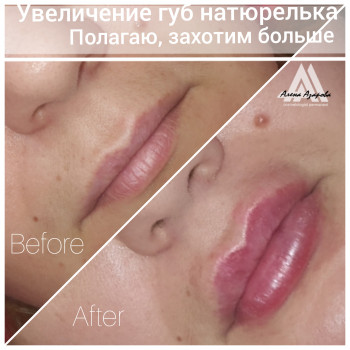 Контурная пластика лица
                    Косметолог Алена Харьков