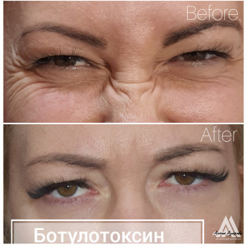 Контурная пластика лица
                    Косметолог Алена Харьков