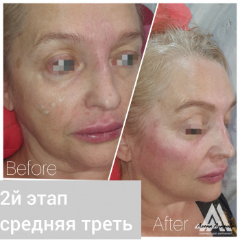 Контурная пластика лица
                    Косметолог Алена Харьков