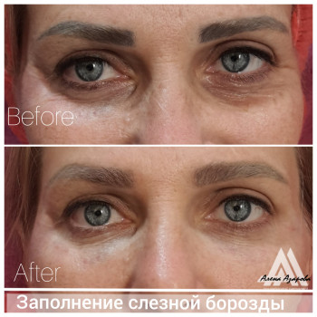 Контурная пластика лица
                    Косметолог Алена Харьков