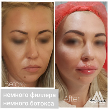 Контурная пластика лица
                    Косметолог Алена Харьков