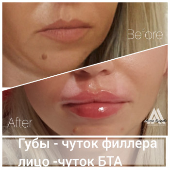 Контурная пластика лица
                    Косметолог Алена Харьков