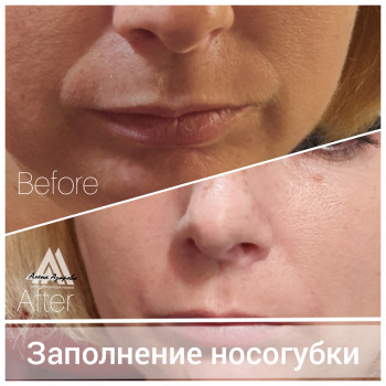 Контурная пластика лица
                    Косметолог Алена Харьков
