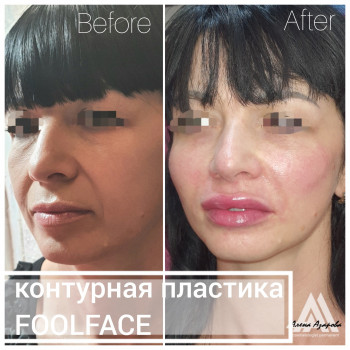 Контурная пластика лица
                    Косметолог Алена Харьков