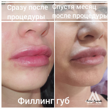Контурная пластика лица
                    Косметолог Алена Харьков