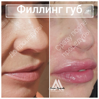 Контурная пластика лица
                    Косметолог Алена Харьков
