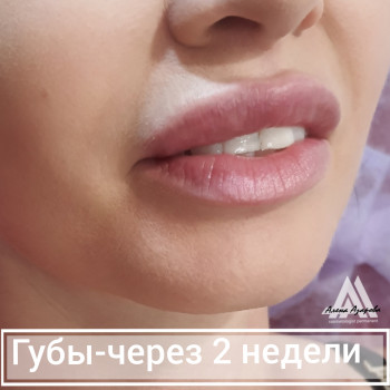 Контурная пластика лица
                    Косметолог Алена Харьков