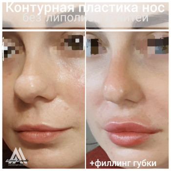 Контурная пластика лица
                    Косметолог Алена Харьков
