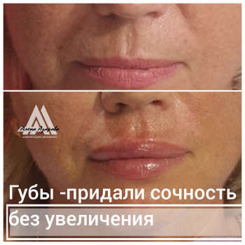 Контурная пластика лица
                    Косметолог Алена Харьков