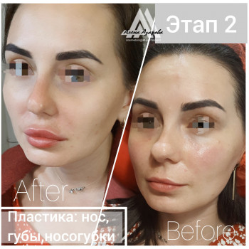 Контурная пластика лица
                    Косметолог Алена Харьков