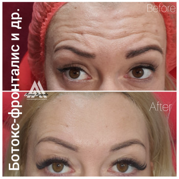 Контурная пластика лица
                    Косметолог Алена Харьков