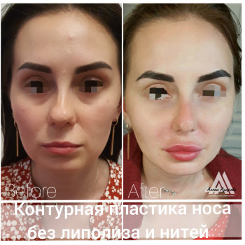 Контурная пластика лица
                    Косметолог Алена Харьков