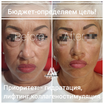 Контурная пластика лица
                    Косметолог Алена Харьков