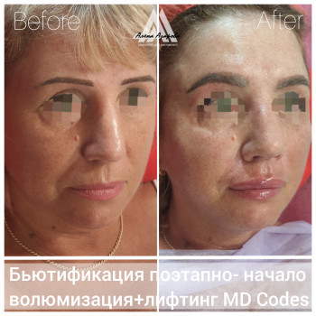Контурная пластика лица
                    Косметолог Алена Харьков