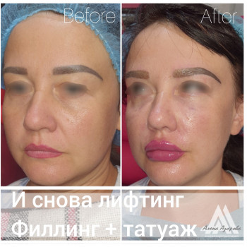 Заполнение носогубной складки
                    Косметолог Алена Харьков