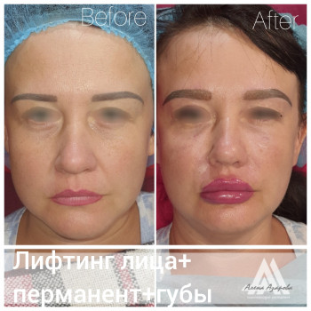 Заполнение носогубной складки
                    Косметолог Алена Харьков