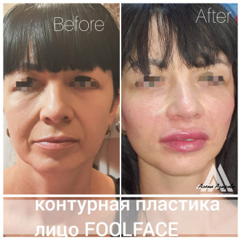 Заполнение носогубной складки
                    Косметолог Алена Харьков