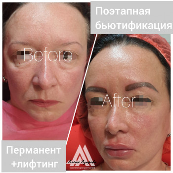 Заполнение носогубной складки
                    Косметолог Алена Харьков