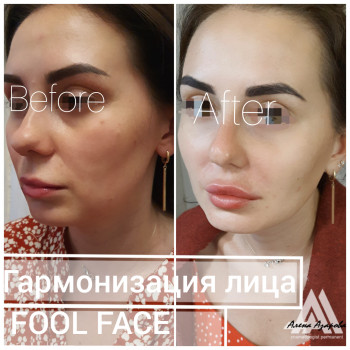 Заполнение носогубной складки
                    Косметолог Алена Харьков