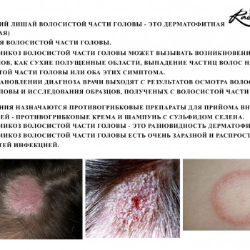 Диагностика трихоскопом
                    Тритментолог Юлия Полтава