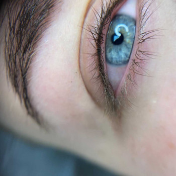 Межресничное заполнение века