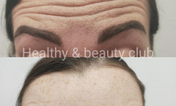 Ботулінотерапія Косметологічний центр Healthy & beauty club Київ