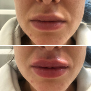 Восстановление объёма )