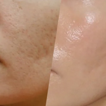 После курса пилингов 4процедуры