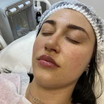 Збільшення губ. Препарат Saypha.
Одразу після процедури - п