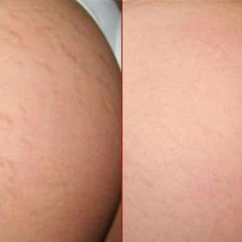 Работа с растяжками после похудения)