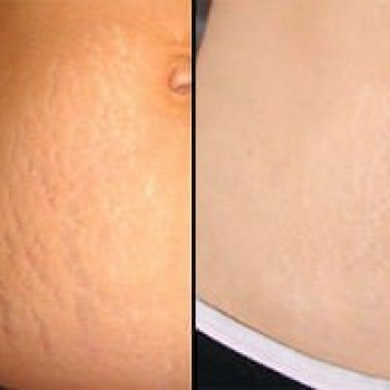 Восстановление после беременности)Редермализация и биостимул