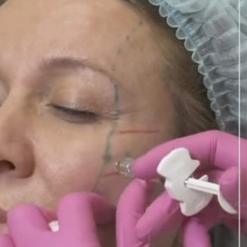 Контурная пластика лица
                    Косметолог-ін'єкціоніст Виктория Полтава