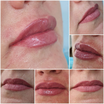 Контурная пластика лица
                    Косметолог-ін'єкціоніст Виктория Полтава