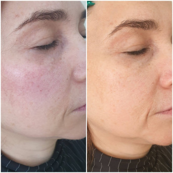 Контурная пластика лица
                    Косметолог-ін'єкціоніст Виктория Полтава