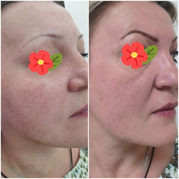 Контурная пластика лица
                    Косметолог-ін'єкціоніст Виктория Полтава