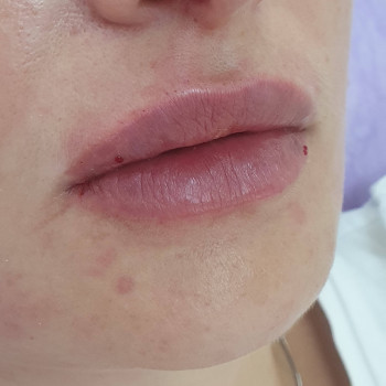 Контурная пластика лица
                    Косметолог-ін'єкціоніст Виктория Полтава