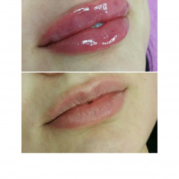 Контурная пластика лица
                    Косметолог-ін'єкціоніст Виктория Полтава