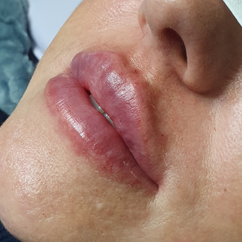 Контурная пластика лица
                    Косметолог-ін'єкціоніст Виктория Полтава