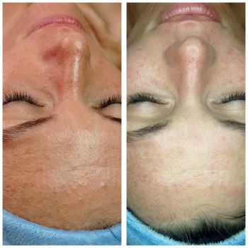 Ультразвукова чистка обличчя
                    Масажний салон Terra SPA Вишневе