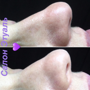 Чистка лица