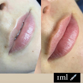 Увеличение губ
                    Косметологічний центр  Київ