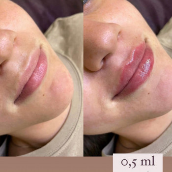 Увеличение губ
                    Косметологічний центр  Київ